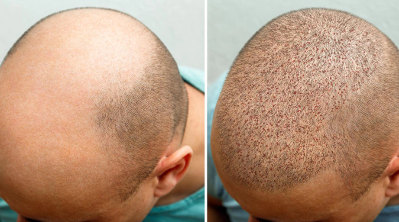 FUT or FUE? What Brighton Clinics Say About Modern Hair Restoration